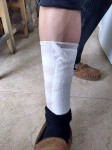 bandaged leg